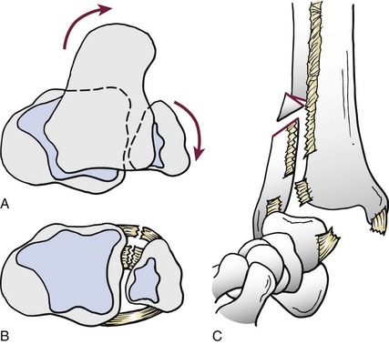 Ankle Fractures | Musculoskeletal Key