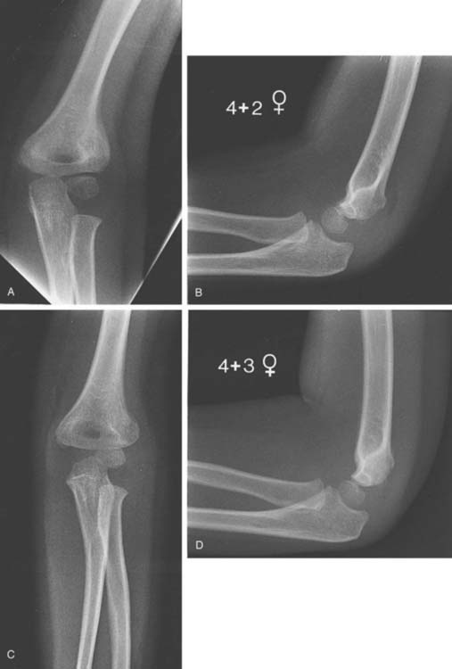 supracondylar fracture right elbow icd 10