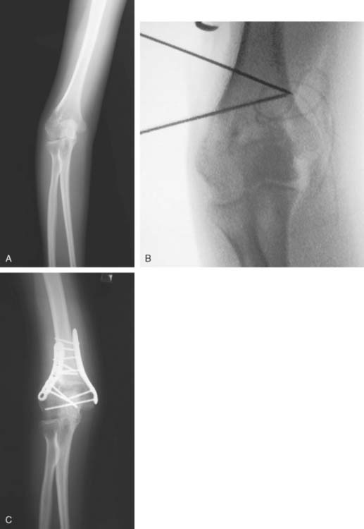 Nonunion And Malunion Of Distal Humerus Fractures | Musculoskeletal Key