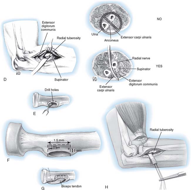 Injury of the Flexors of the Elbow: Biceps Tendon Injury ...