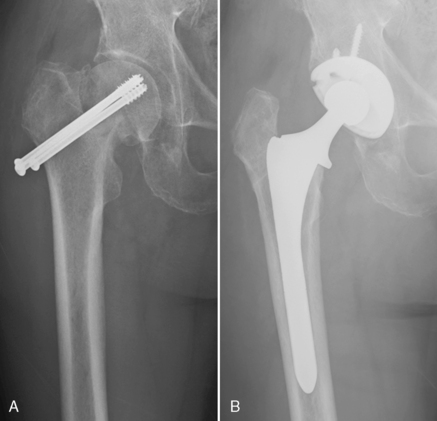 Femoral Neck Fractures: Treatment Of Nonunion | Musculoskeletal Key