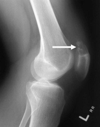 gout knee tophaceous patella tendon quadriceps lateral radiograph demonstrates proximal pole erosive lucency within change figure musculoskeletalkey