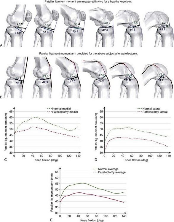 Biomechanics And Vibroarthrography Of The Patellofemoral Joint ...