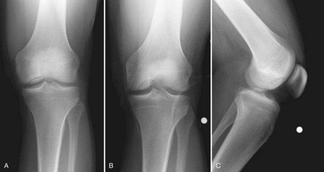 A, Standard anteroposterior. 