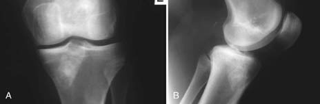 Revision Anterior Cruciate Ligament Reconstruction | Musculoskeletal Key