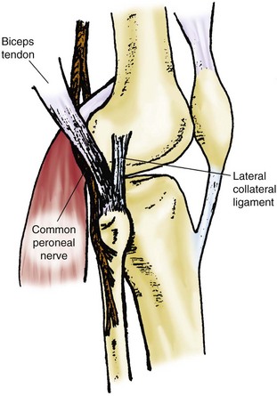 The Dislocated Knee | Musculoskeletal Key