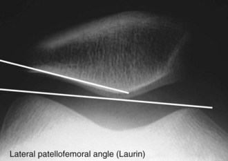 Example of patellar orientation with a lateral glide and/or tilt