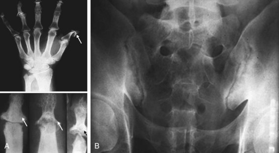 Overview Of Psoriatic Arthritis | Musculoskeletal Key