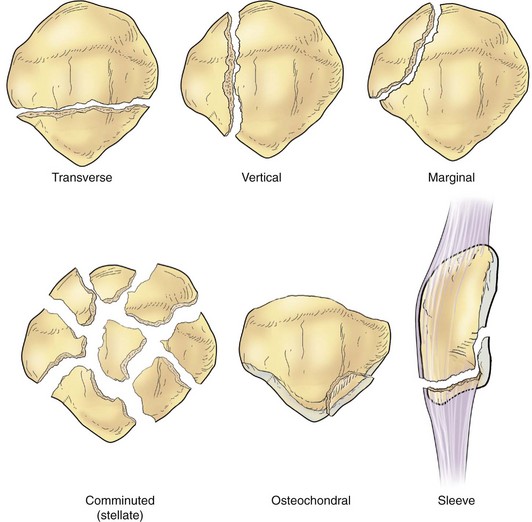 Knee Fractures Types