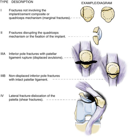 Fractures Of The Patella | Musculoskeletal Key