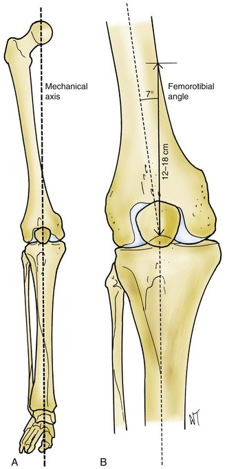 Influence of intentional femoral component flexion in navigated TKA on gap  balance and sagittal anatomy