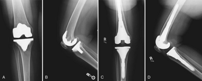Mobile Bearing Total Knee Arthroplasty Musculoskeletal Key