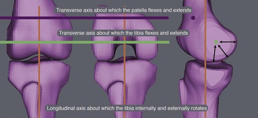 Kinematic Alignment In Total Knee Arthroplasty Musculoskeletal Key