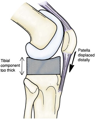 Complications of Total Knee Arthroplasty | Musculoskeletal Key