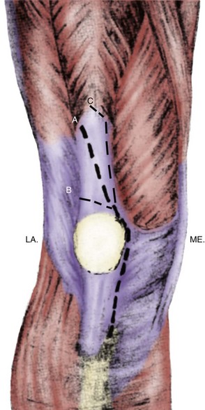 Extensor Mechanism Disruption After Total Knee Arthroplasty