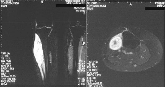 Soft Tissue Tumors Of The Knee Musculoskeletal Key