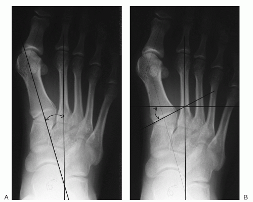 Anatomy and Biomechanics of The Foot and Ankle | Musculoskeletal Key