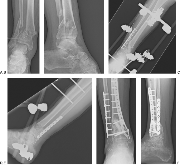 Stepwise Approach To Anklepilon Trauma And External Fixation