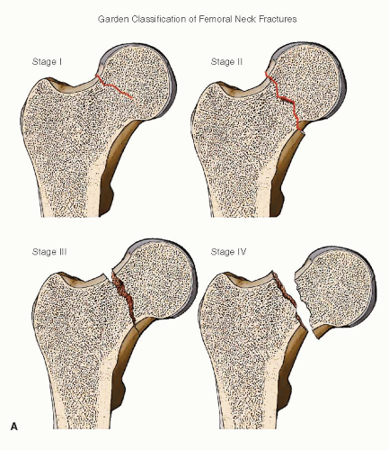 Garden Femoral Neck Fracture