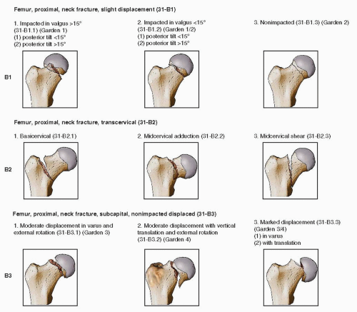 hemiarthroplasty femoral neck fracture