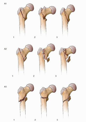 Intertrochanteric Hip Fractures: Intramedullary Hip Screws ...
