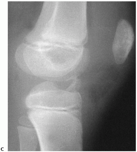 Pediatric Fractures Musculoskeletal Key Pediatric Fractures Musculoskeletal Key