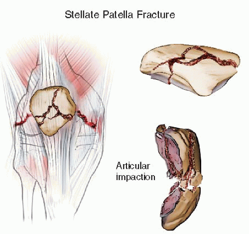 Stellate patella fracture with articular impaction. 