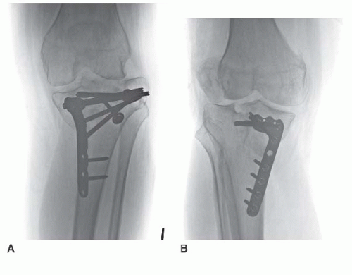 tibial plateau compression fracture treatment