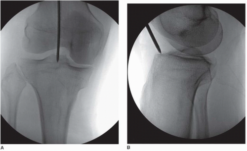 Flexible intramedullary nails for unstable fractures of the tibia in  children | Bone & Joint