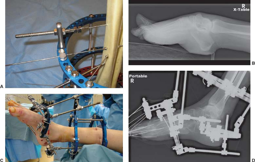 Circular external fixator application for midshaft tibial