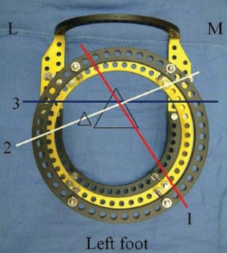 Circular external fixator application for midshaft tibial