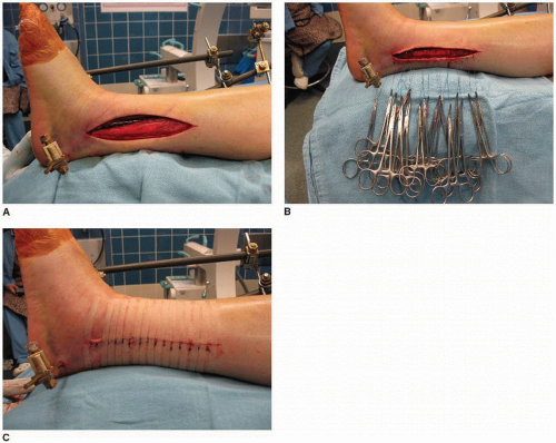 Tibial Pilon Fractures Staged Internal Fixation