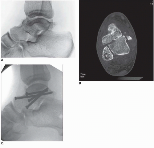 Talus Fractures: Open Reduction Internal Fixation | Musculoskeletal Key