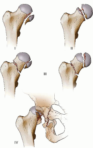 Surgical Dislocation of the Hip for Fractures of the Femoral Head ...