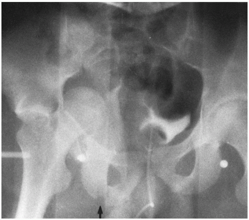 Pelvic Fractures | Musculoskeletal Key