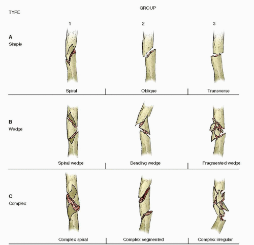 Humeral Shaft Fractures Radiology Key - vrogue.co
