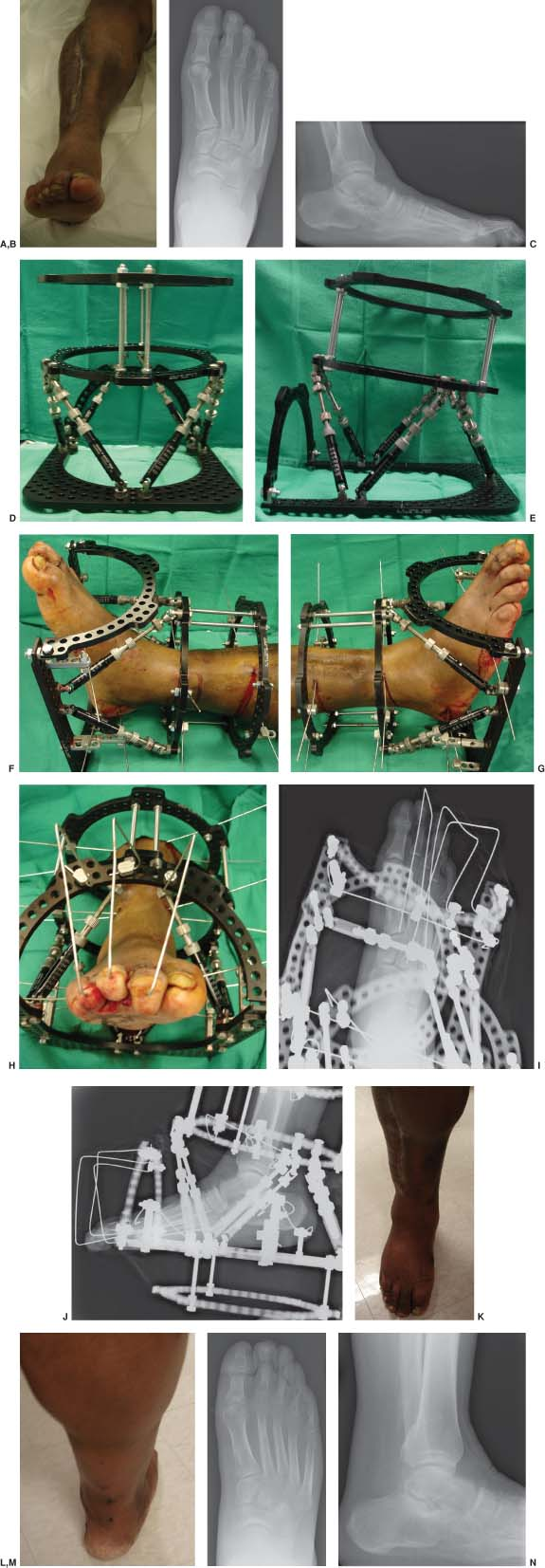 Minimally invasive distal tibial osteotomy and correction of deformity with  the Taylor Spatial Frame – Orthoracle LuanMD