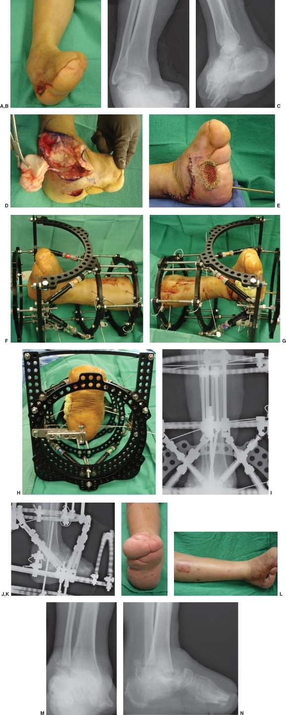 Minimally invasive distal tibial osteotomy and correction of deformity with  the Taylor Spatial Frame – Orthoracle LuanMD