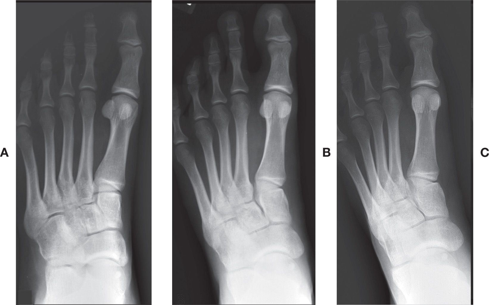 xray normal foot