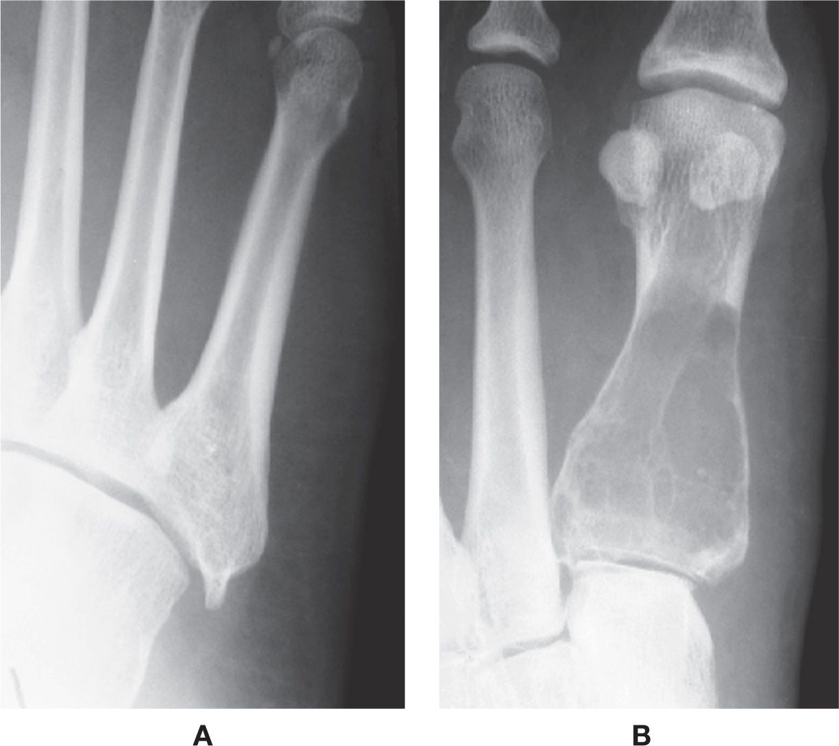 metatarsal spur