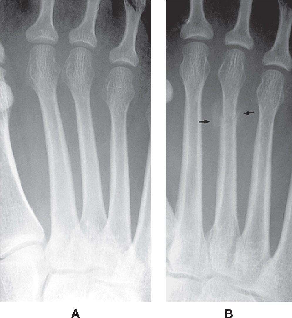 15: Fractures and Related Conditions: Fundamentals ...