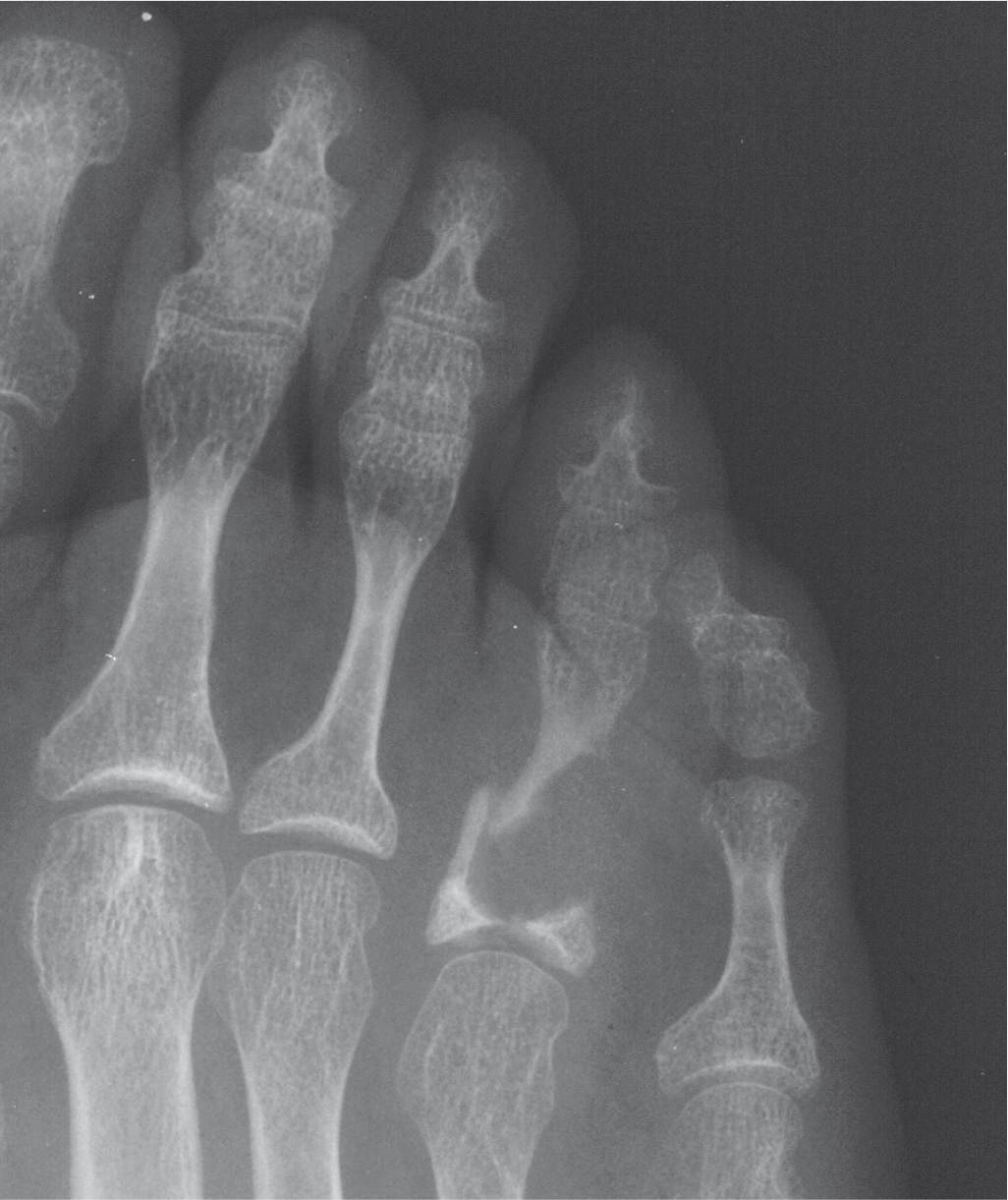 non displaced toe fracture