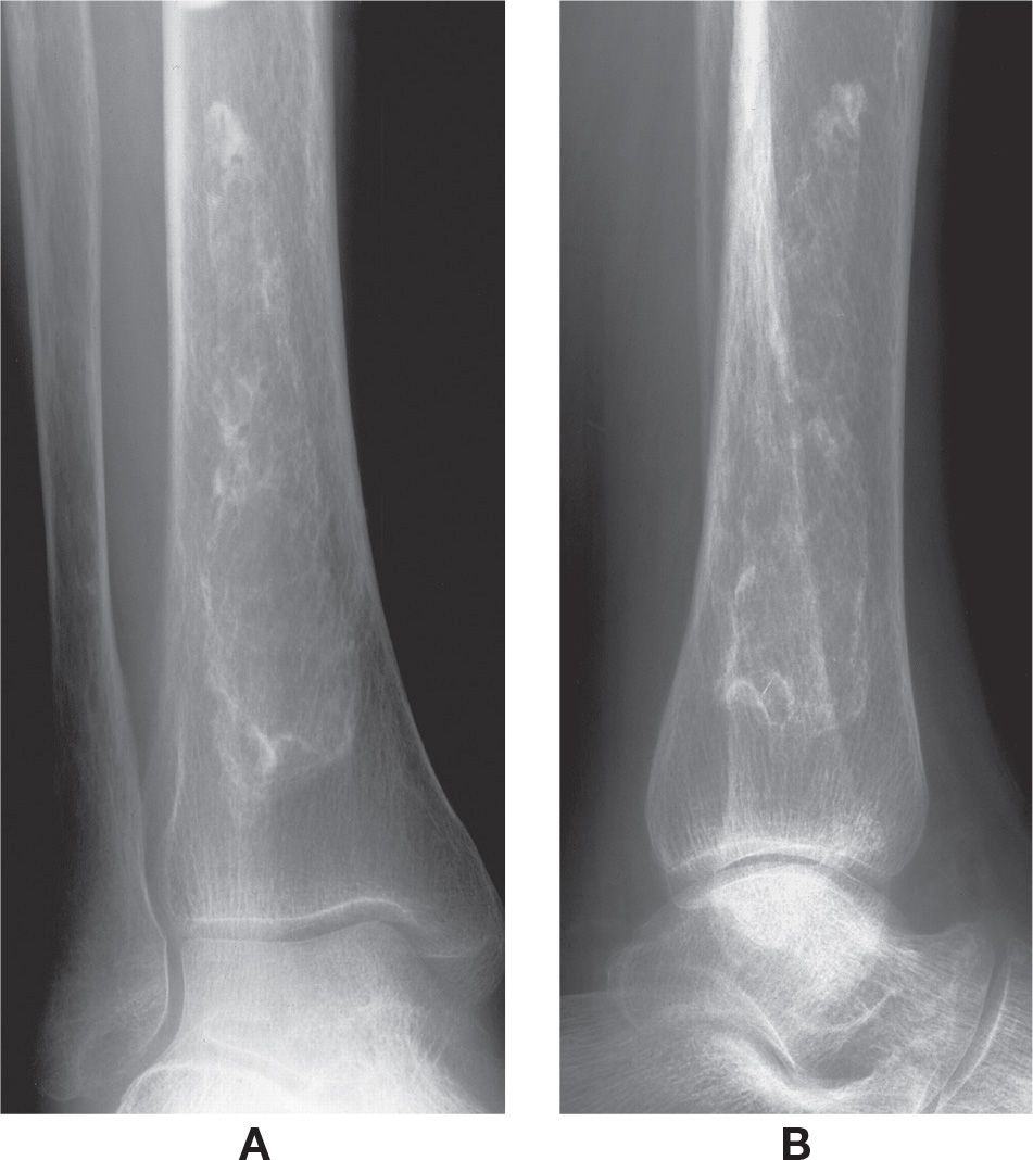 17: Osteonecrosis and Osteochondrosis | Musculoskeletal Key