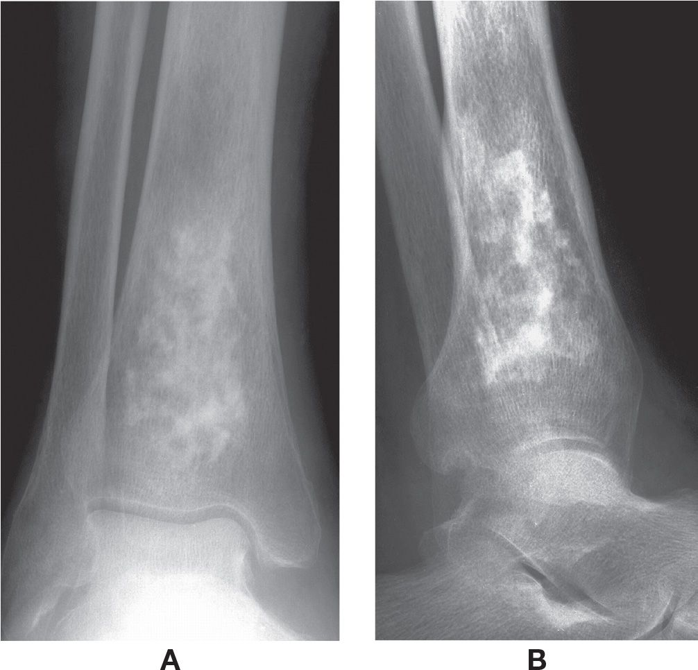 17: Osteonecrosis and Osteochondrosis | Musculoskeletal Key