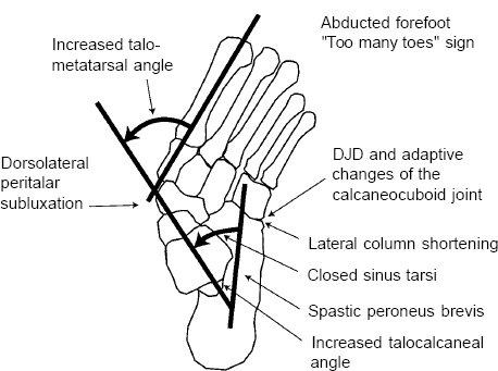 Adult Flatfoot Syndrome | Musculoskeletal Key