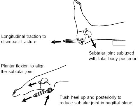 Percutaneous Pinning of Talar Neck Fractures | Musculoskeletal Key