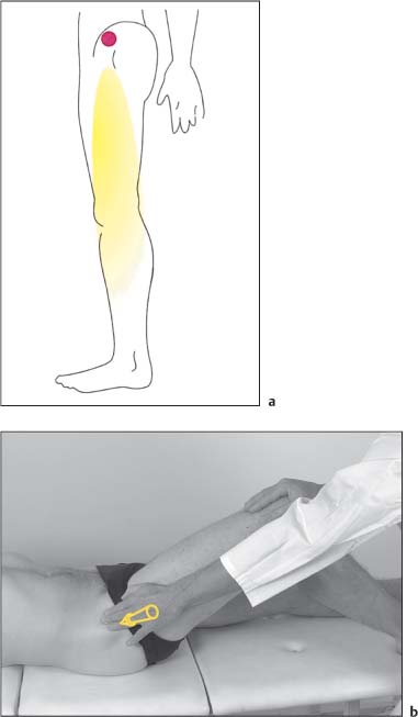 Nonradicular Pain: Spondylogenic And Myofascial Pain Syndromes ...