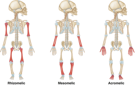 Dwarfism (Skeletal Dysplasia) & Other Causes of Short Stature