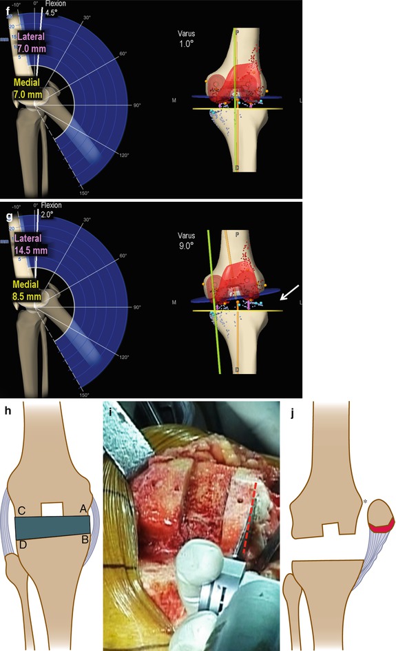 Osteotomies In Total Knee Arthroplasty Musculoskeletal Key