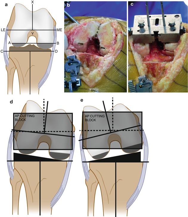 thesis of knee arthroplasty